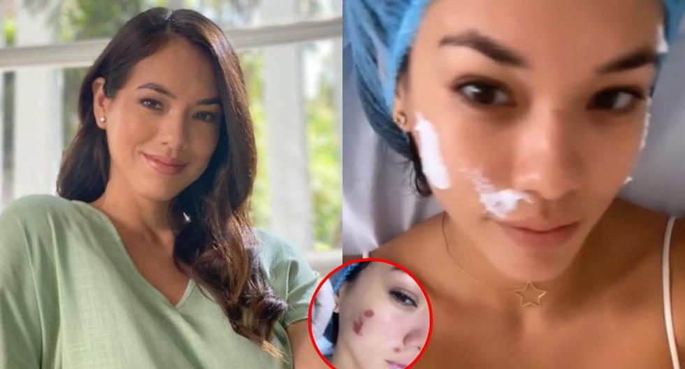Jazmín Pinedo admite quemaduras en el rostro: "Espero que no haya consecuencias" (VIDEO) 1 1668895469 Jazmin Pinedo admite quemaduras en el rostro Espero que no